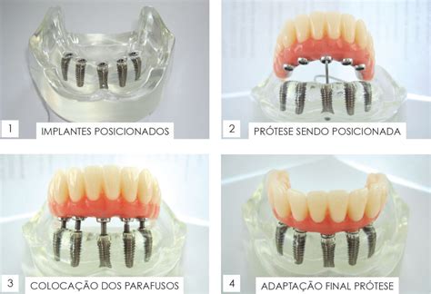 Vespera De Fenda De 5 Implantes